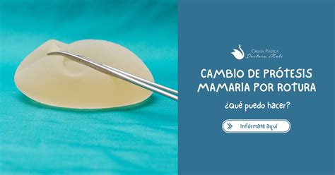 Representación visual de una prótesis mamaria rodeada por una cápsula fibrosa engrosada