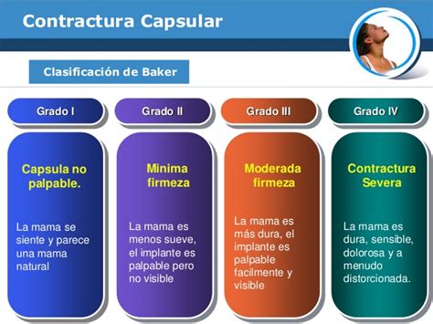 Infografía comparando los cuatro grados de la escala de Baker para la contractura capsular