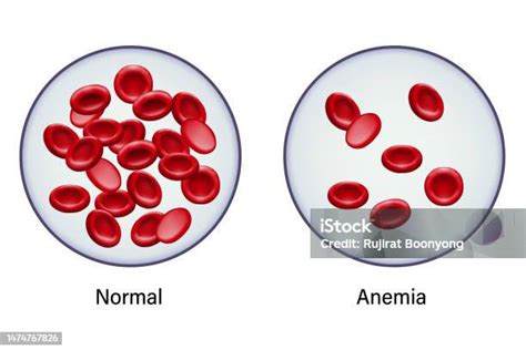 Diagrama de un glóbulo rojo sano y uno afectado por anemia megaloblástica