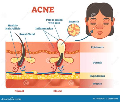 Diagrama mostrando las capas de la piel y cómo el acné las afecta.