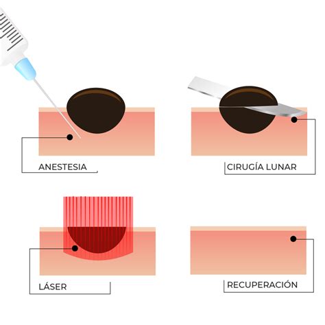 procedimiento de electrocoagulación de un lunar