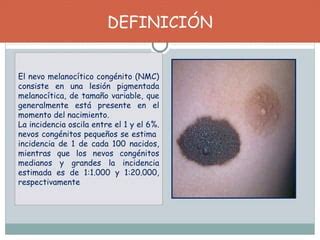 infografía sobre el Nevus Melanocítico Congénito Gigante