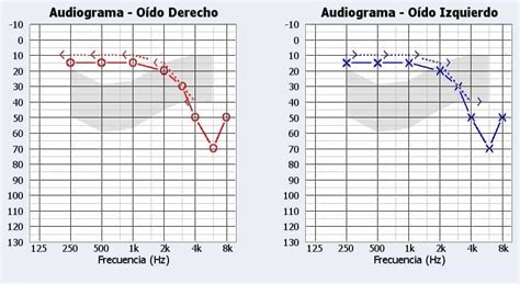 Audiograma típico mostrando pérdida auditiva