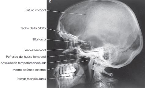 Radiografía lateral de cráneo mostrando la silla turca y apófisis clinoides