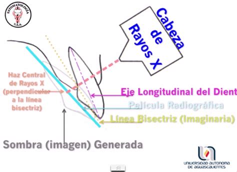 Diagrama mostrando la angulación del rayo central para la proyección Caldwell de SPN