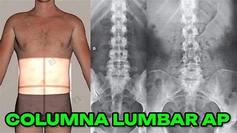 Radiografía AP de columna torácica mostrando la alineación vertebral