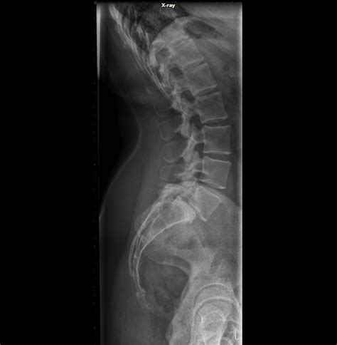 Radiografía lateral de columna lumbar mostrando la lordosis y los pedículos